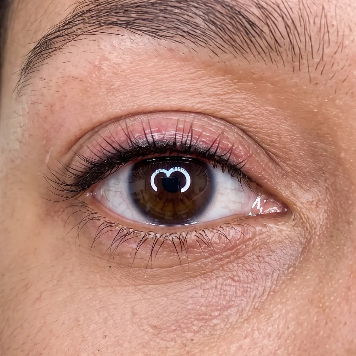Abgeheilte Wimpernkranzverdichtung: feine dunkle Pigmentierung zwischen den oberen Wimpernwurzeln, ohne Wing